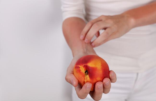 Peach allergy (Source: Albina Gavrilovic/Shutterstock.com) Peach allergy (Source: Albina Gavrilovic/Shutterstock.com)